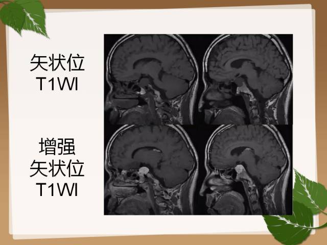【PPT】鞍旁病例分析