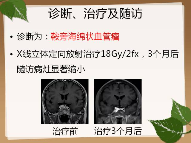 【PPT】鞍旁病例分析
