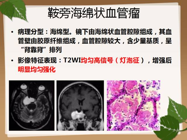 【PPT】鞍旁病例分析