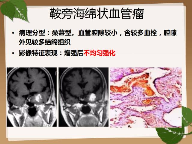 【PPT】鞍旁病例分析