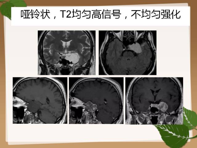 【PPT】鞍旁病例分析