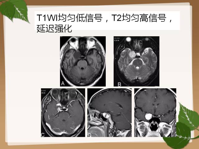 【PPT】鞍旁病例分析