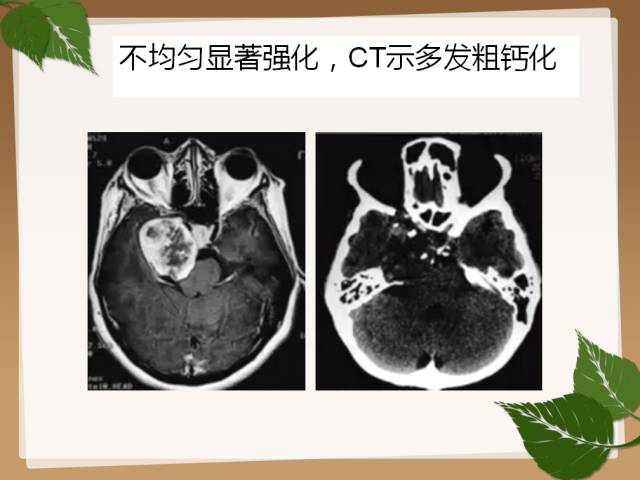 【PPT】鞍旁病例分析
