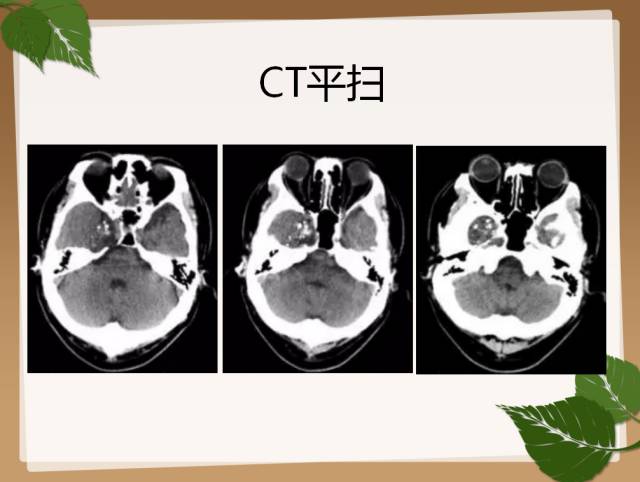 【PPT】鞍旁病例分析