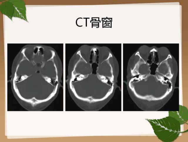 【PPT】鞍旁病例分析