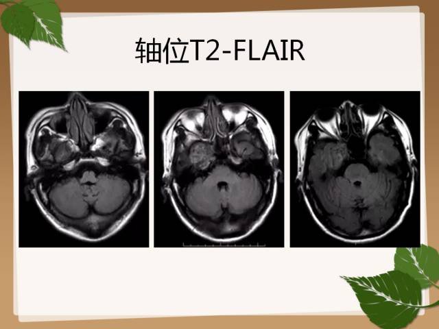 【PPT】鞍旁病例分析