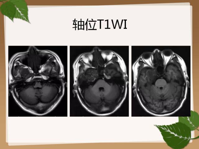 【PPT】鞍旁病例分析