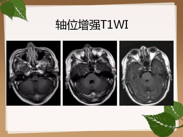 【PPT】鞍旁病例分析