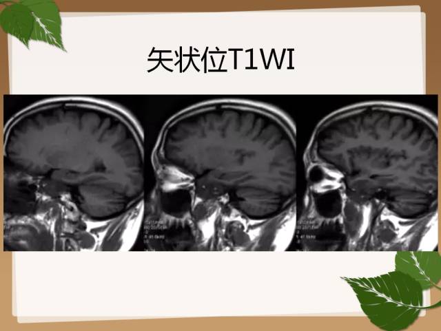 【PPT】鞍旁病例分析