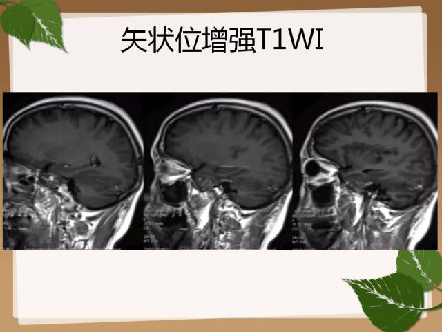 【PPT】鞍旁病例分析