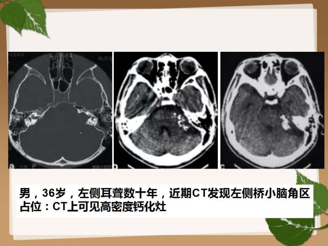 【PPT】鞍旁病例分析