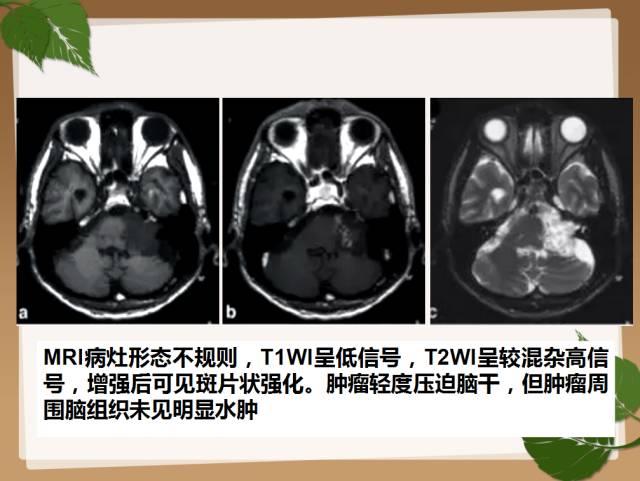 【PPT】鞍旁病例分析