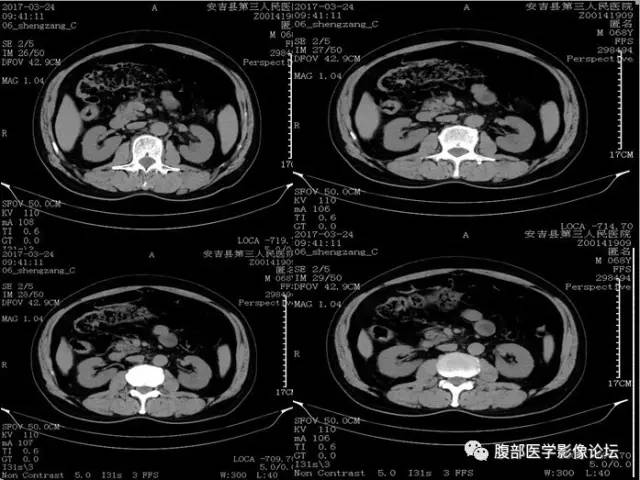 【病例】多房囊性肾癌1例CT 【病例】多房囊性肾癌1例CT