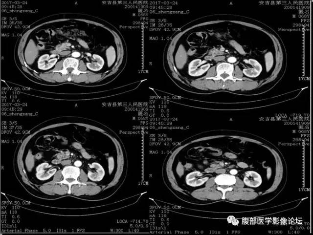 【病例】多房囊性肾癌1例CT 【病例】多房囊性肾癌1例CT