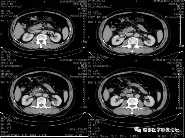 【病例】多房囊性肾癌1例CT 【病例】多房囊性肾癌1例CT