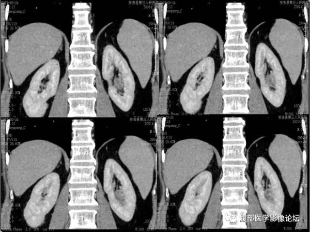 【病例】多房囊性肾癌1例CT 【病例】多房囊性肾癌1例CT