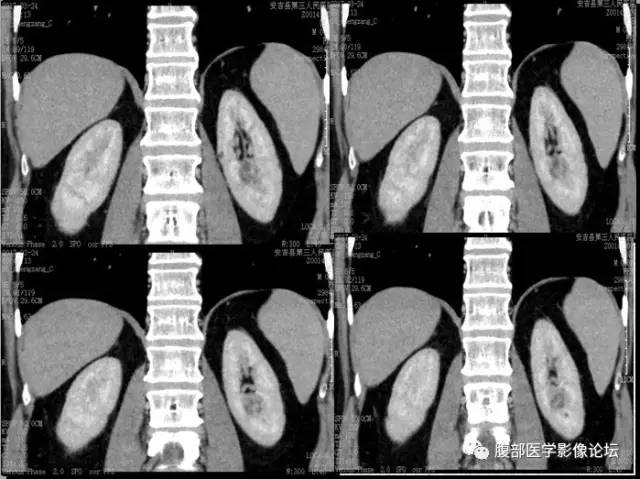 【病例】多房囊性肾癌1例CT 【病例】多房囊性肾癌1例CT