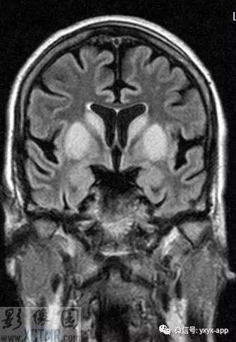 【病例】克-雅病1例MR影像诊断分析 【病例】克-雅病1例MR影像诊断分析