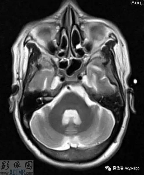 【病例】克-雅病1例MR影像诊断分析 【病例】克-雅病1例MR影像诊断分析