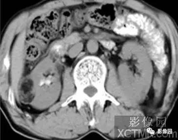 【病例】右肾血管平滑肌脂肪瘤1例影像诊断