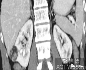 【病例】右肾血管平滑肌脂肪瘤1例影像诊断