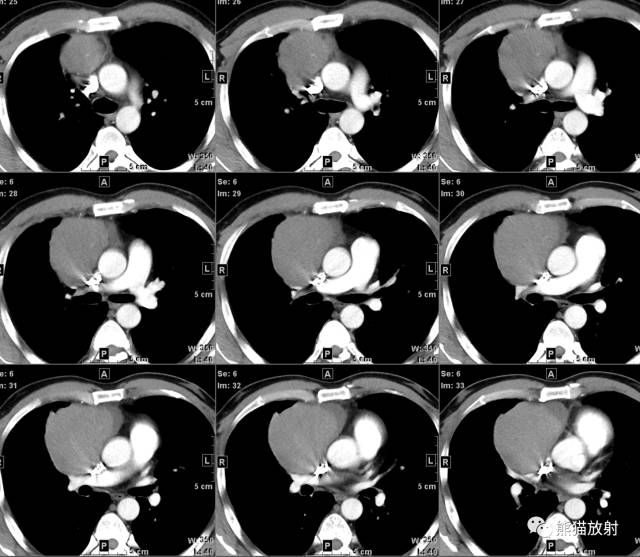 【病例】纵隔生殖细胞肿瘤(精原细胞瘤)1例CT 【病例】纵隔生殖细胞肿瘤(精原细胞瘤)1例CT