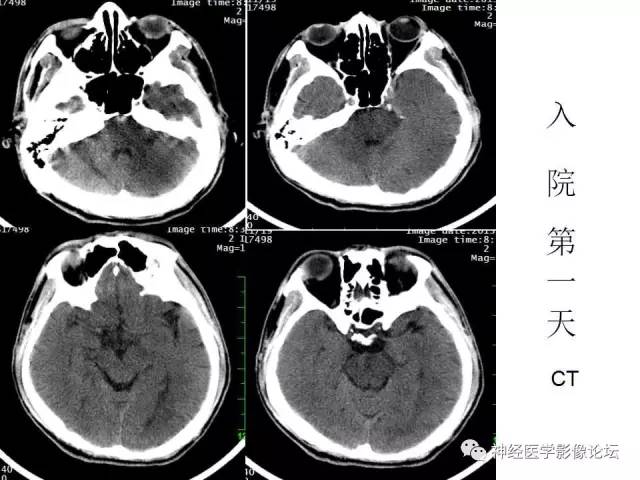 【病例】脑实质结核1例MR