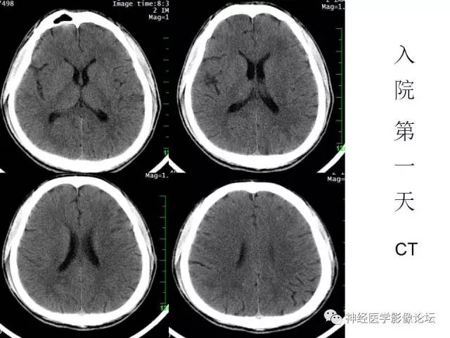 【病例】脑实质结核1例MR