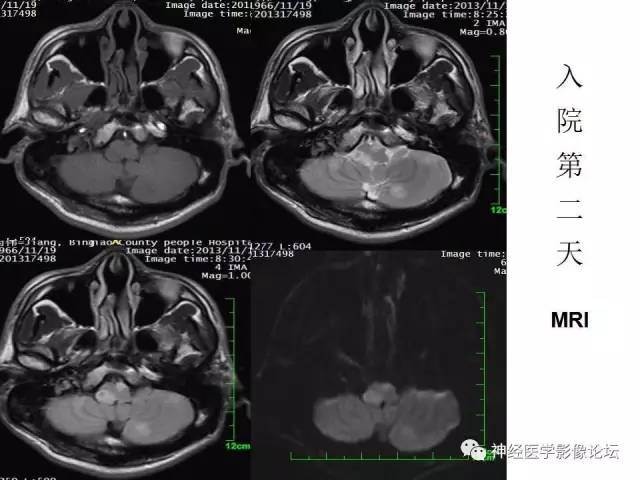 【病例】脑实质结核1例MR
