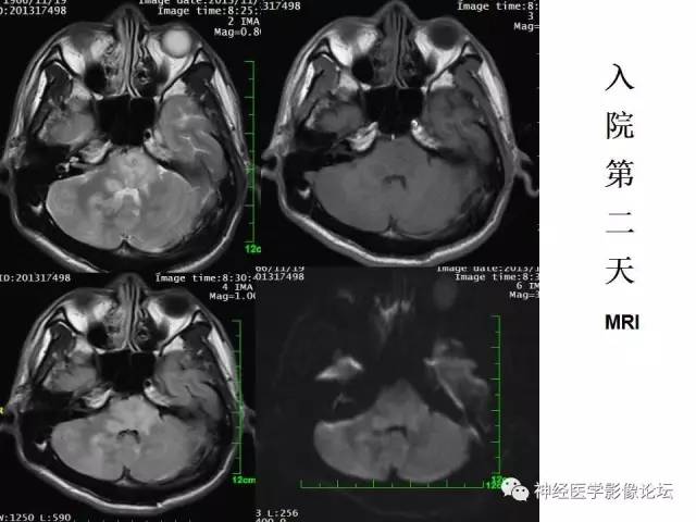 【病例】脑实质结核1例MR