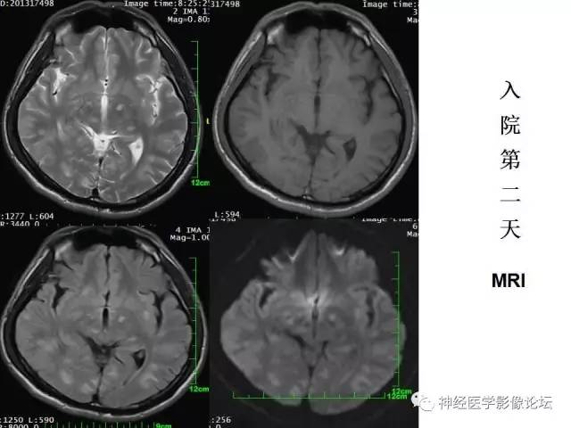 【病例】脑实质结核1例MR