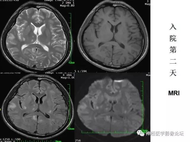 【病例】脑实质结核1例MR