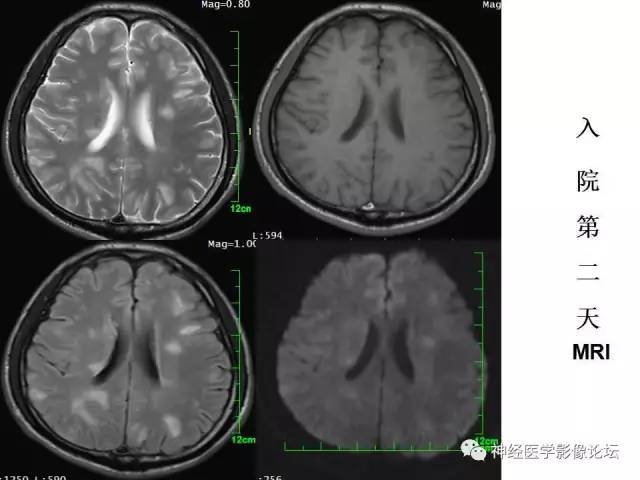 【病例】脑实质结核1例MR