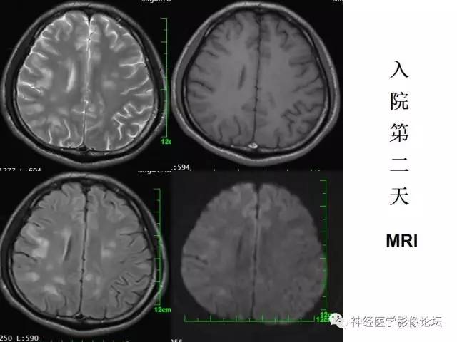【病例】脑实质结核1例MR