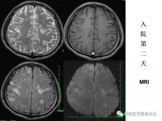 【病例】脑实质结核1例MR