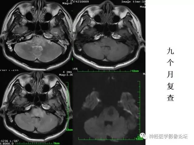 【病例】脑实质结核1例MR