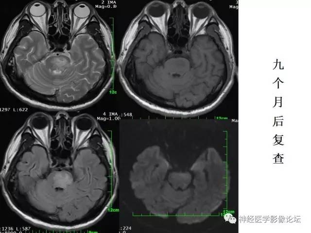 【病例】脑实质结核1例MR