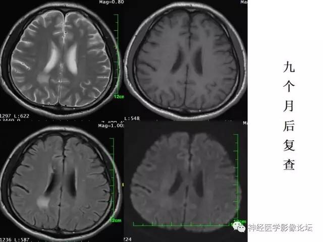 【病例】脑实质结核1例MR