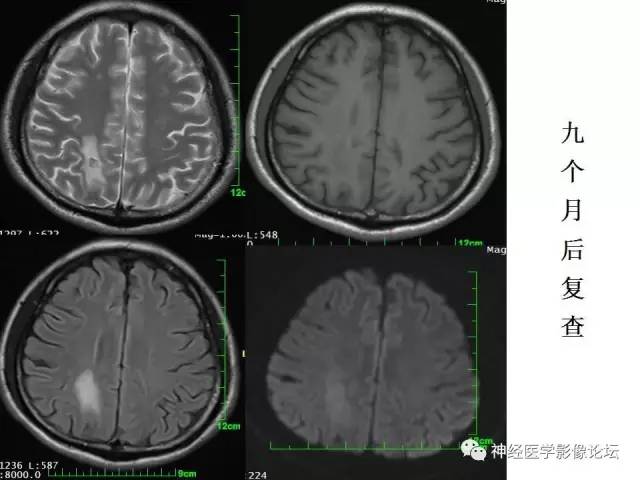 【病例】脑实质结核1例MR
