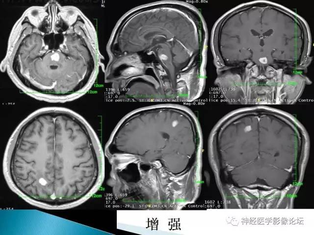 【病例】脑实质结核1例MR