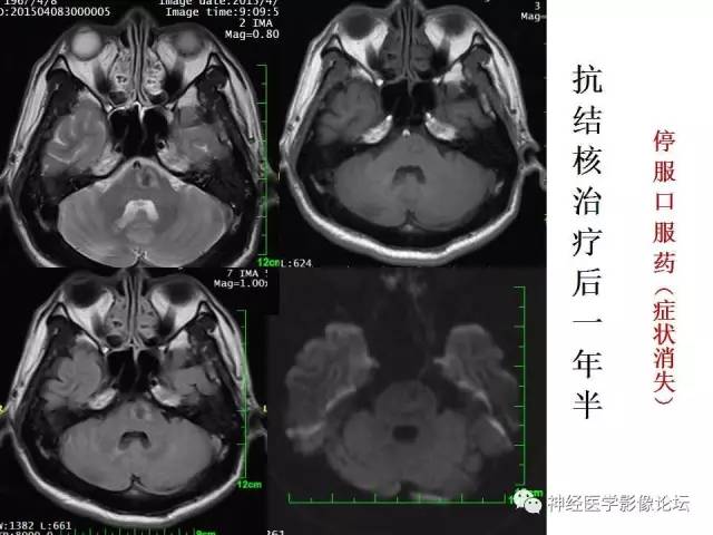 【病例】脑实质结核1例MR