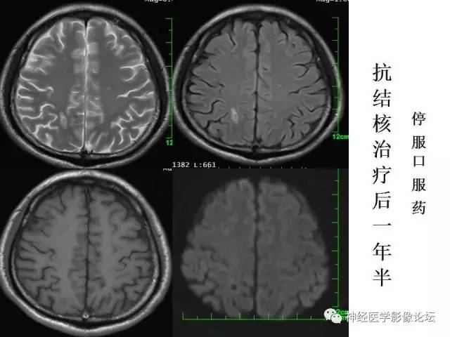 【病例】脑实质结核1例MR