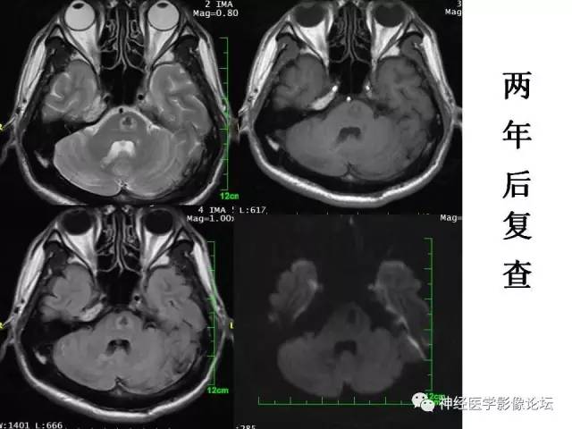【病例】脑实质结核1例MR