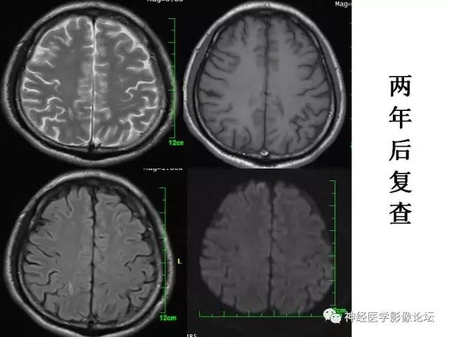 【病例】脑实质结核1例MR