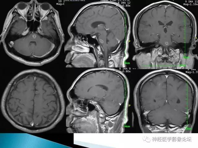 【病例】脑实质结核1例MR