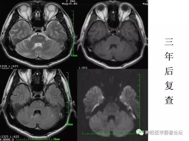 【病例】脑实质结核1例MR