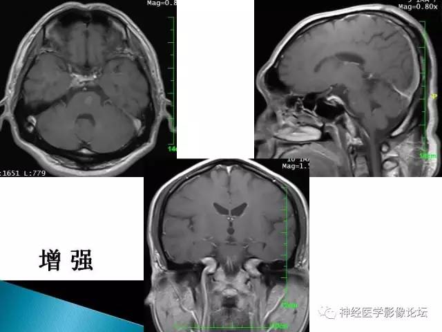 【病例】脑实质结核1例MR
