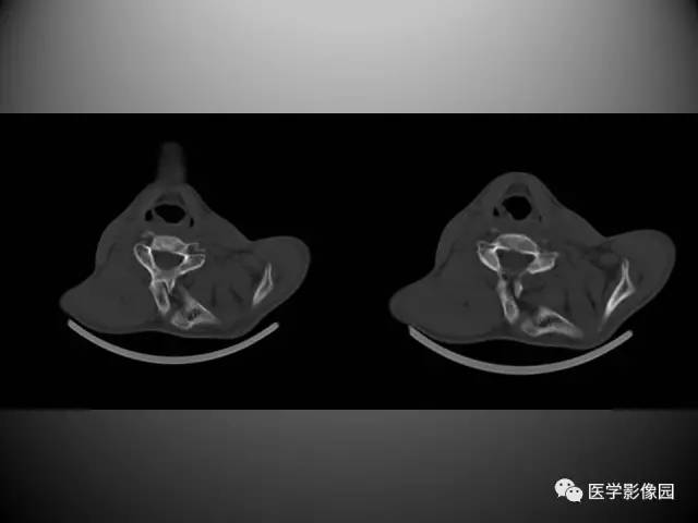 【病例】先天性肩胛骨高位症1例CT影像表现