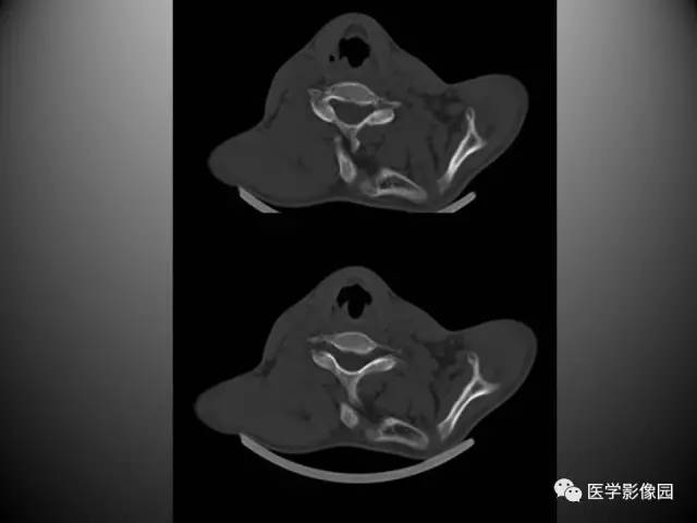 【病例】先天性肩胛骨高位症1例CT影像表现