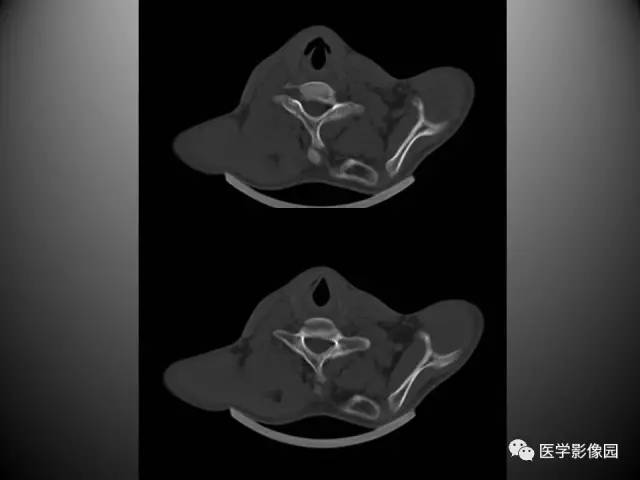 【病例】先天性肩胛骨高位症1例CT影像表现